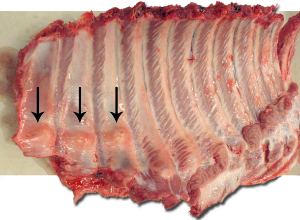 Multiple distal rib fractures with callus formation (arrows).