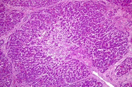 Necrosis centrolubulillar del hepatocito y una destrucción masiva de la estructura hepática con inflamación mononuclear y megalocitos
