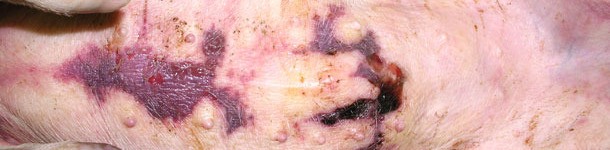 Accumulation de liquide sous la peau dans la région sternale
