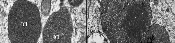 Microscopie électronique d'un ganglion lymphatique d'un porc avec du PCV2-SD