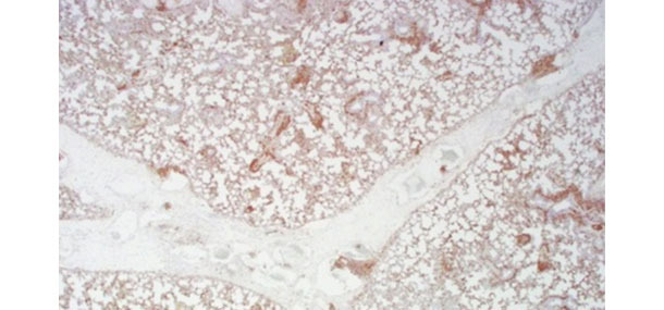 Coloration positive (marron) pour le PCV2 par immunohistochimie sur un poumon de porc avec œdème inter lobulaire grave et pneumonie interstitielle diffuse