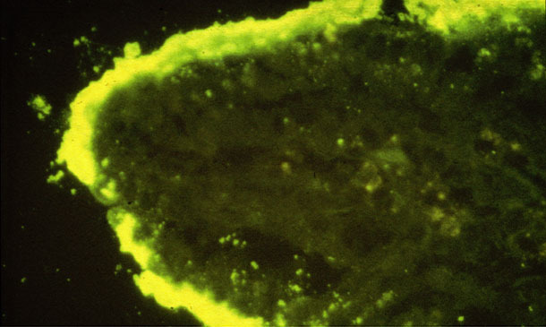 Colonies denses de E coli adhérentes à une villosité intestinale 