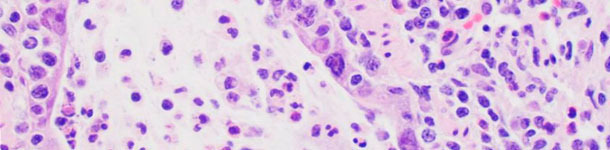 Lesiones microscópicas compatibles con la infección por influenza, incluyen necrosis del epitelio bronquiolar donde el virus se replica