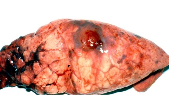 Lésions d’App chronique sur le lobe diaphragmatique avec des dépôts de fibrine.