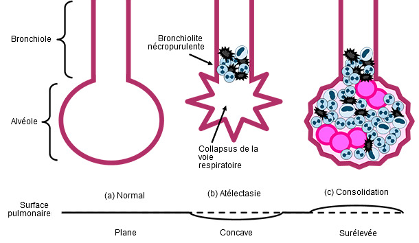 Bronchioles