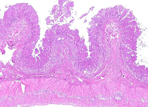 Iléon. Déplétion marquée des lymphocytes et inflammation granulomateuse des plaques de Peyer dans l’iléon d’un porc atteint par la maladie systémique associée au PCV2. Coloration à l’hématoxyline et à l’éosine.