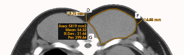 Medidas lineales, curvilíneas y de área obtenidas en imágenes de tomografía computarizada de la zona del lomo (espesor de grasa subcutánea superior- D y lateral F, y área y perímetro del lomo-G).