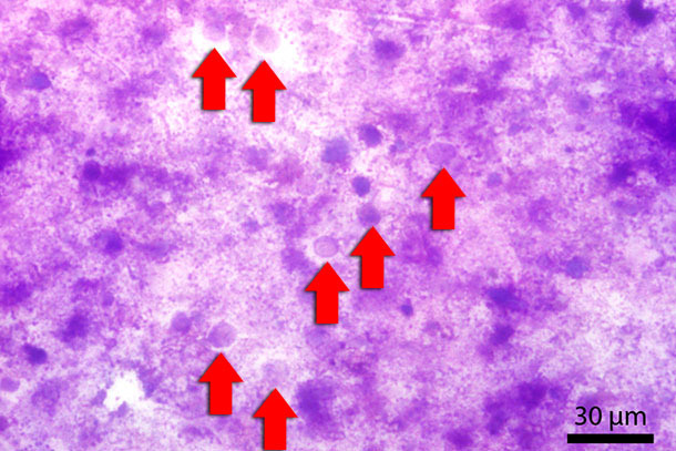 Frottis fécal coloré avec Diff-Quick. Les flèches rouges indiquent les Blastocystis.