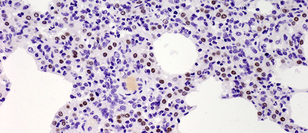 les points marron indiquent le noyau des pneumocytes de type II identifiés avec des anticorps anti-TTF-1. On a observé une augmentation significative du nombre de cellules positives à 10 jours après l’infection avec un isolat de type I sous-type 1