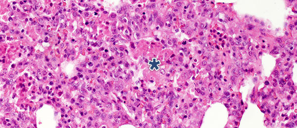 débris nécrotiques intra-alvéolaires et accumulation de cellules inflammatoires (astérisque) dans le tissu pulmonaire à 10 jours après PI avec un isolat du virus du SDRP de type 1 sous-type 1 H. E. 200 x.