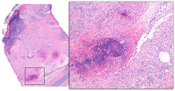 Biopsie de la pointe de l’oreille d’un porc avec une affection chronique. Les changements épidermiques comprennent une ulcération avec une inflammation sous-jacente, la formation d’une croûte séro-cellulaire et de l’acanthose de l’épiderme. Les vaisseaux du derme profond sont atteints par de la thrombose et de la vascularite