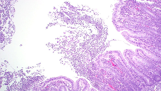 Colite ulcérative fibrinopurulente multifocale ou localement étendue.
