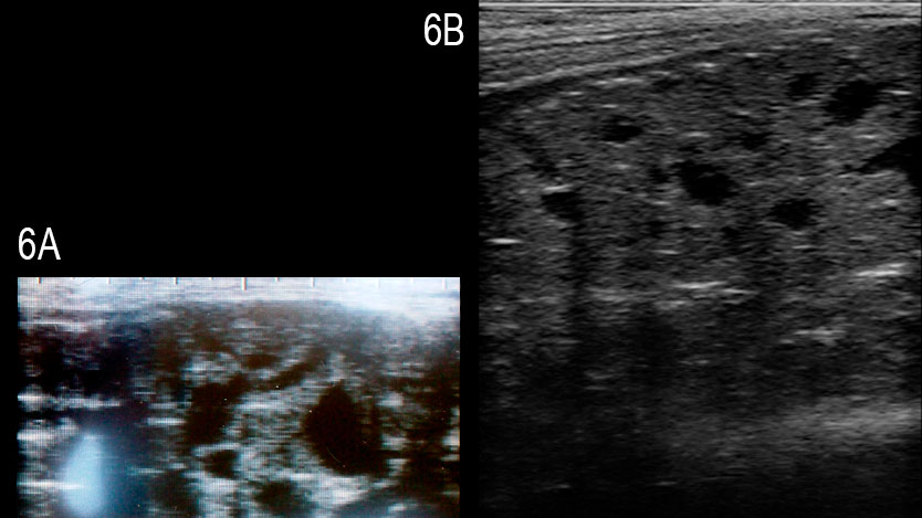 <p>Figure&nbsp;6: Images de la glande bulbo-ur&eacute;trale d'un verrat atteint par de multiples kystes an&eacute;chog&eacute;niques &nbsp;bien d&eacute;finis de diff&eacute;rentes tailles (A) et d'un verrat sain (B) (Grahofer et al., 2016).</p>
