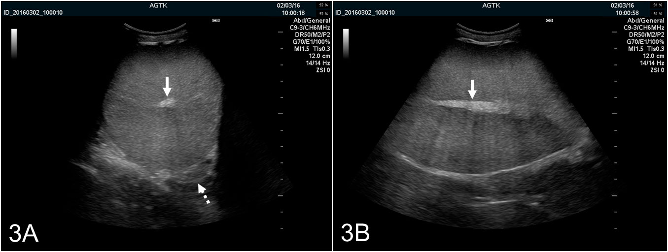 <p>Figure 3:&nbsp;<span style="font-size: 13px;">Images &eacute;chographiques du testicule d'un verrat explor&eacute; transversalement (A) et longitudinalement (B). Le rete testis est repr&eacute;sent&eacute; comme une t&acirc;che hyper&eacute;chog&eacute;nique dans le centre du testicule (fl&egrave;che pleine). Le parenchyme testiculaire pr&eacute;sente une &eacute;chog&eacute;nicit&eacute; moyenne et une &eacute;chotexture homog&egrave;ne. L'image transversale donne aussi une visualisation optimale du corps de l'&eacute;pididyme &nbsp;(fl&egrave;che pointill&eacute;e), qui est normalement d'apparence &eacute;chographique semblable &agrave; celle du testicule.</span></p>
