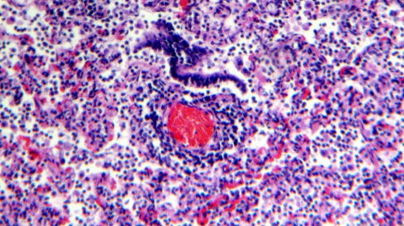 Figure 5. Infiltrat de lymphocytes p&eacute;rivasculaires.
