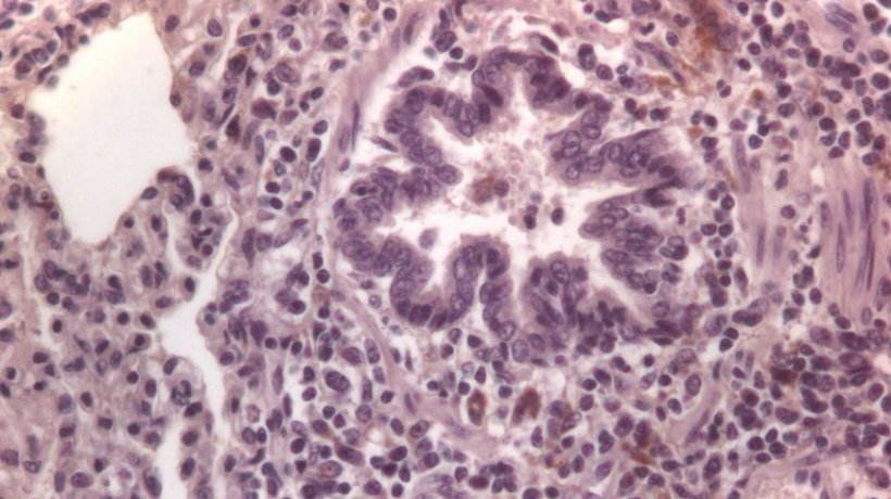 Figure 3: Cellules immunocolor&eacute;es contre le PCV2 dans le poumon.
