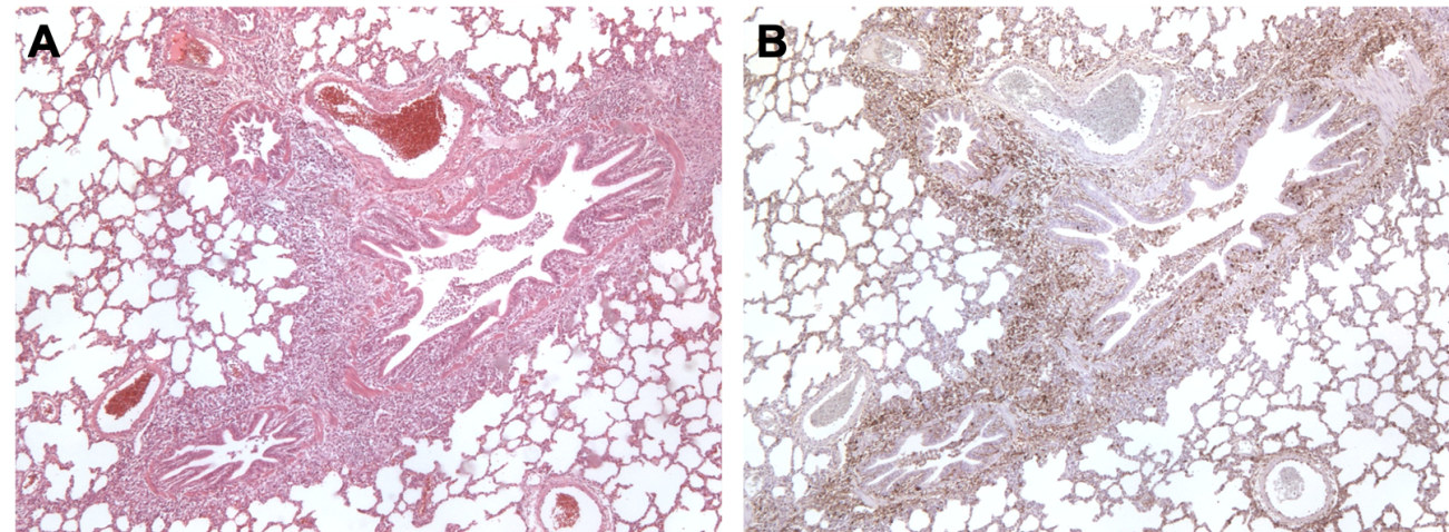 <p>Figure 3. Poumon d'un porc co-infecté par <em>M. hyopneumoniae</em> et PCV2. <strong>A</strong>: Zone d'hyperplasie lymphoïde péribronchiolaire causée par <em>M. hyopneumoniae</em>. <strong>B</strong>: Grande quantité d'antigène PCV2 dans la même zone d'hyperplasie lymphoïde.</p>