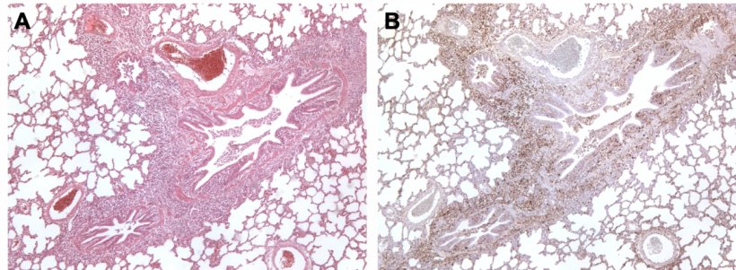 Figure 3. Poumon d&#39;un porc co-infect&eacute; par M. hyopneumoniae et PCV2. A: Zone d&#39;hyperplasie lympho&iuml;de p&eacute;ribronchiolaire caus&eacute;e par M. hyopneumoniae. B: Grande quantit&eacute; d&#39;antig&egrave;ne PCV2 dans la m&ecirc;me zone d&#39;hyperplasie lympho&iuml;de.
