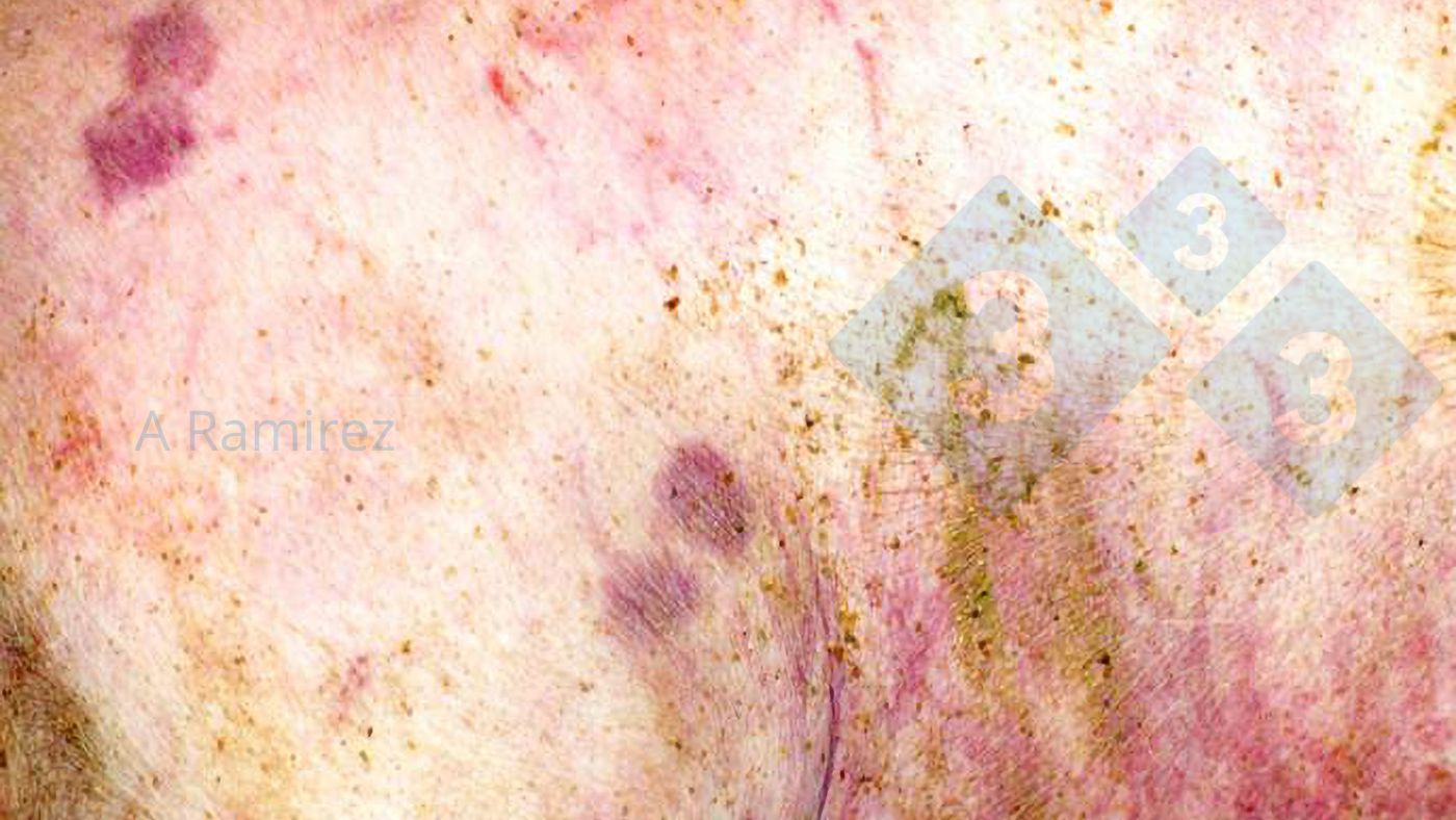 Figure 1. L&eacute;sion cutan&eacute;e presque pathognomonique en forme de losange (diamant).
