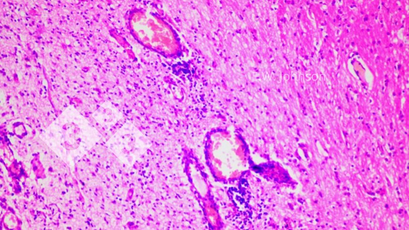 Image 2. Manchons p&eacute;rivasculaires et gliose. Cerveau.
