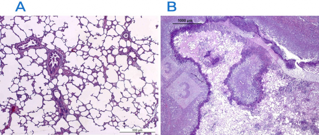 <p>Figure 2 : Coloration à l'hématoxyline-éosine d'un poumon normal (A) et d'un poumon atteint (B). Le poumon en B est atteint d'une pleuropneumonie fibrino-nécrotique causée par<em> Actinobacillus pleuropneumoniae.</em></p>