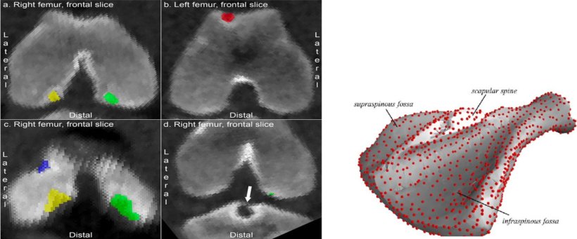 Figure 5. &Agrave; gauche : vues frontale et lat&eacute;rale de t&ecirc;tes f&eacute;morales pr&eacute;sentant des l&eacute;sions au niveau de la surface articulaire. &Agrave; droite : image tridimensionnelle de l'omoplate.

