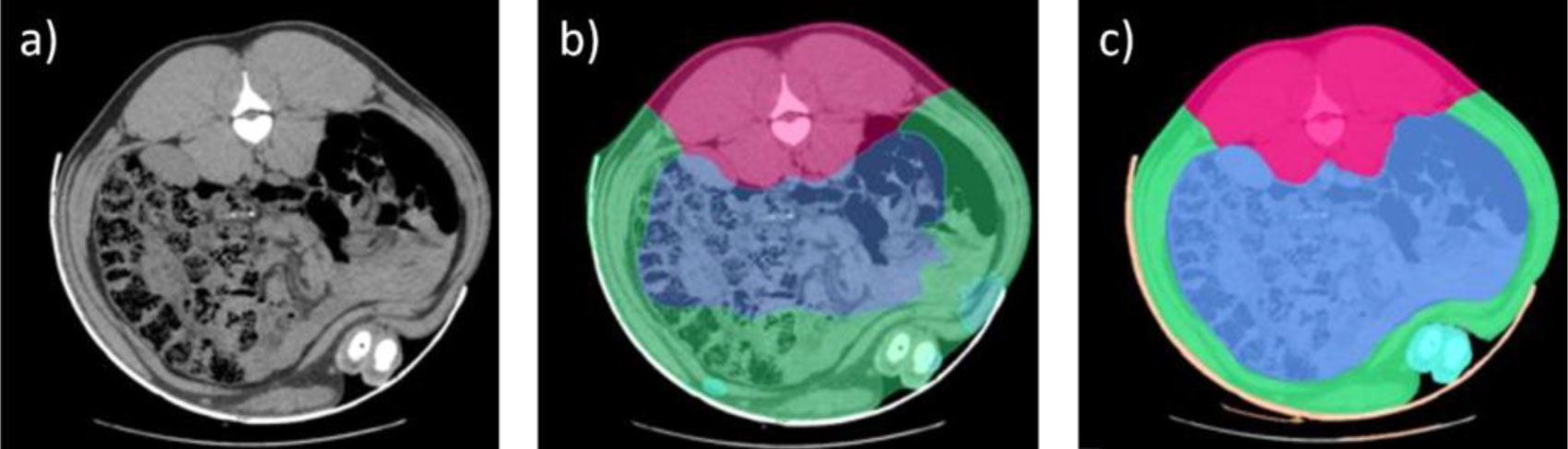 <p>Figure 1. Images de TC, a) sans segmentation, b) segmentation avant mise en &oelig;uvre de l'IA, c) avec corrections manuelles des segments utilis&eacute;s pendant le processus d'entra&icirc;nement de l'IA. La zone rose correspond &agrave; la longe, la zone bleue aux intestins et la zone verte &agrave; la paroi abdominale, tandis que la zone turquoise correspond au segment de l'extr&eacute;mit&eacute;.</p>
