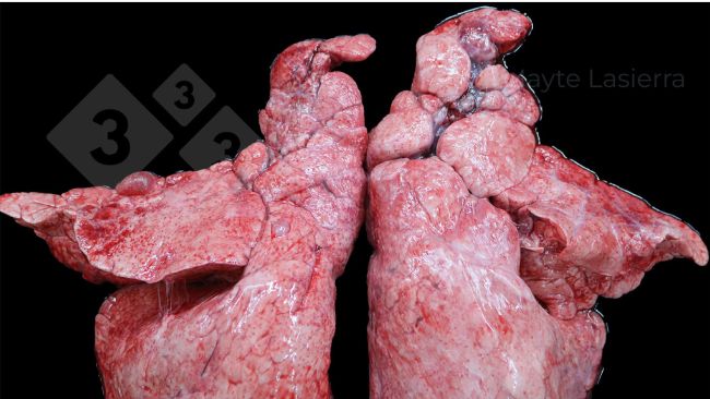 Pleur&eacute;sie cr&acirc;niale
