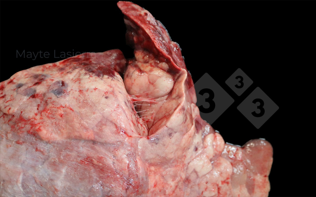 <p>Pleurésie crâniale</p>