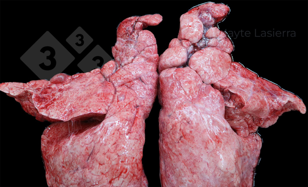 <p>Pleurésie crâniale</p>