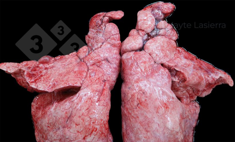 Pleurésie crâniale