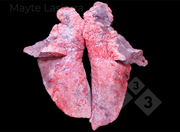 <p>Processus de bronchopneumonie</p>