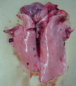 Pleuresie pulmonaire