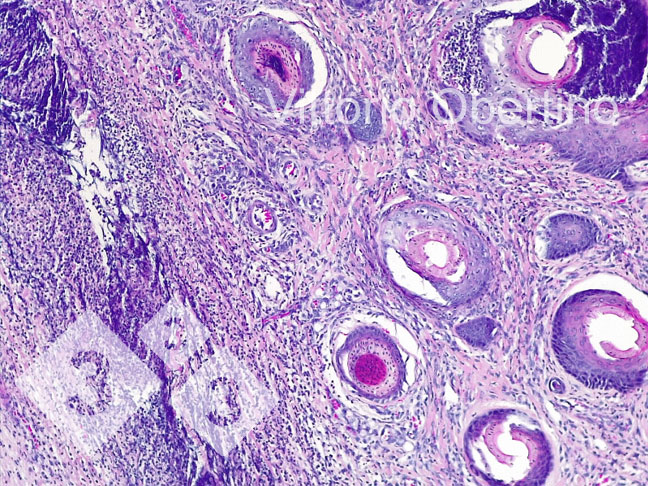 <p>Figure 8. Nombril. Zone dermique localement étendue constituée de fibroplasie avec fibroblastes activés et de nombreux petits vaisseaux immatures (tissu de granulation nouvellement formé), infiltrat inflammatoire multifocal avec une prédominance de cellules lymphoplasmacellulaires ; dans certaines structures vasculaires, il existe un infiltrat inflammatoire granulocytaire qui entoure la paroi vasculaire et l'infiltre focalement (vascularite leucotarienne).</p>