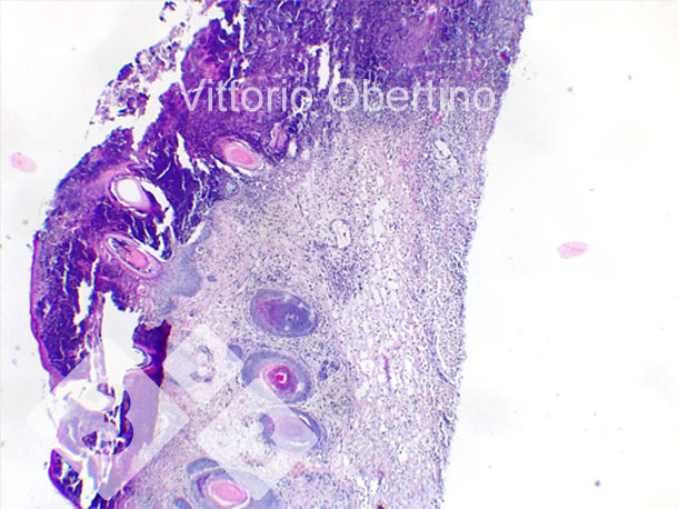 <p>Figure 9. Peau. Érosion épithéliale focale dans laquelle la couche superficielle est remplacée par un matériel éosinophile amorphe à granulaire abondant avec des débris cariorectiques (nécrose) et des granulocytes neutrophiles dégénérés et viables abondants. Multifocalement, l'épithélium apparaît modérément à fortement hyperplasique avec une hyperkératose orthokératosique modérée à sévère. Il existe également une présence multifocale de croûtes. Le derme apparaît diffus et modérément fibreux.</p>